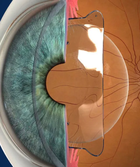 ICL Surgery - Dr praveen saluja