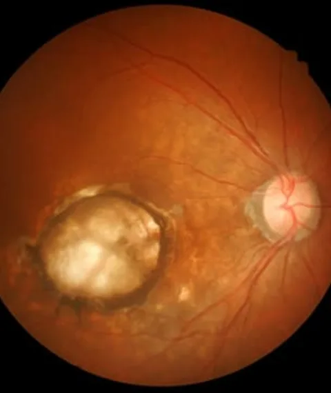 Macular Degeneration -saluja eye care center