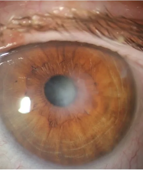 Cornea traetment - Saluja eye care